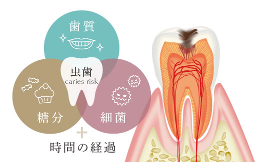 虫歯＝歯質＋糖分＋細菌＋時間の経過