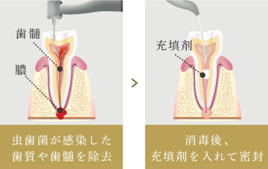 虫歯菌が感染した歯質や歯髄を除去したら、消毒後に充填剤を入れて密封