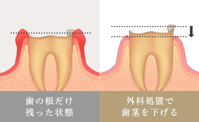歯冠長延長術