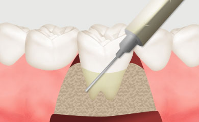 歯周組織再生療法