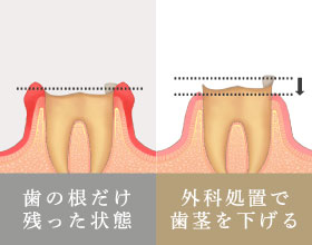 外科処置で歯茎を下げる