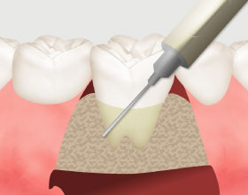 歯周組織再生療法