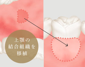 上顎の結合組織と角化歯肉を移植