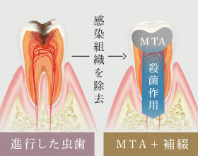 歯髄温存療法