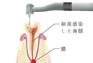 細菌感染した歯髄、膿