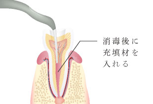 消毒後に充填剤を入れる