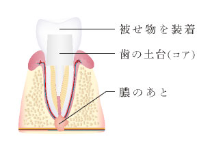 被せ物を装着、歯の土台、膿のあと