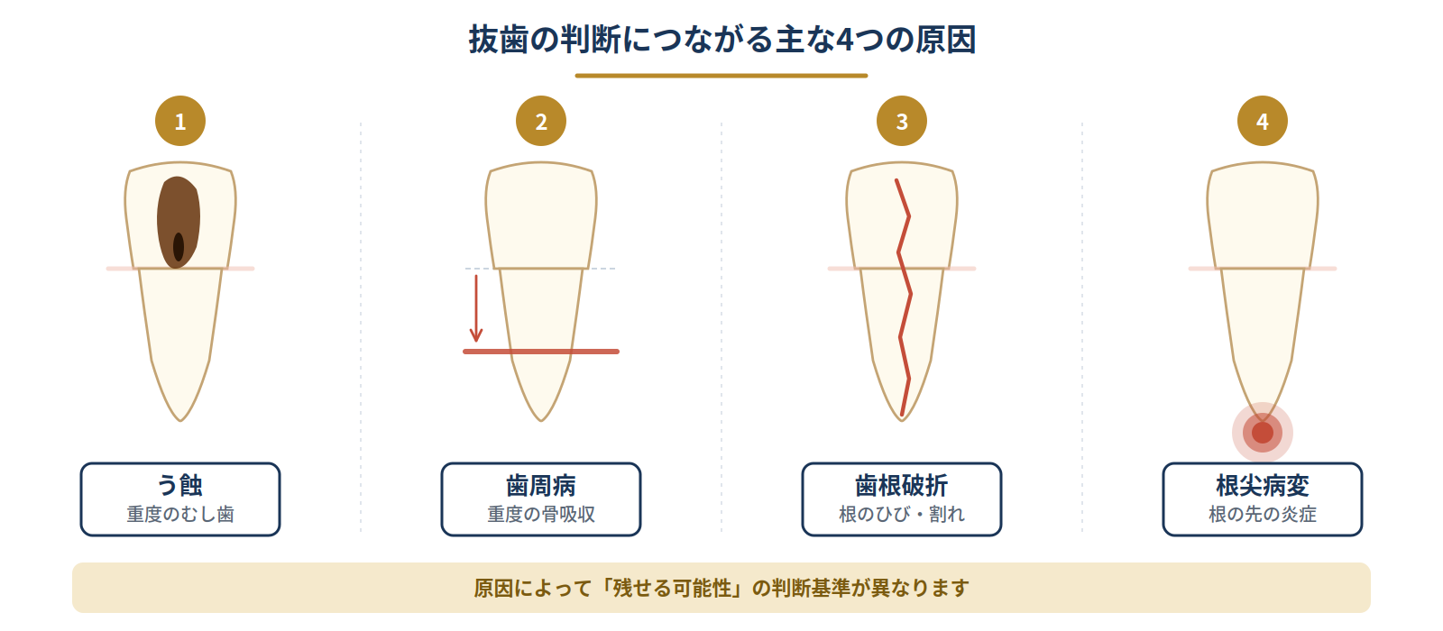 抜歯の判断につながる主な4つの原因（う蝕・歯周病・歯根破折・根尖病変）の図解